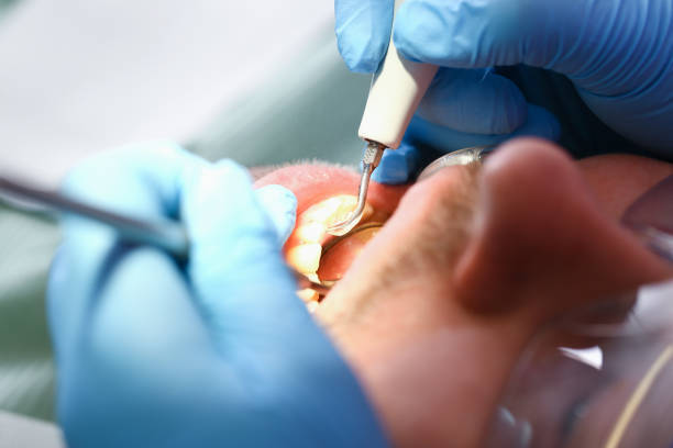 Best Emergency Tooth Extraction in North Pearsall, TX